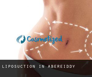 Liposuction in Abereiddy
