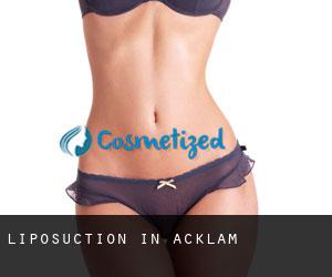 Liposuction in Acklam