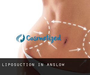 Liposuction in Anslow