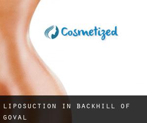 Liposuction in Backhill of Goval