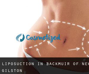 Liposuction in Backmuir of New Gilston