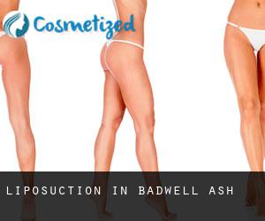 Liposuction in Badwell Ash