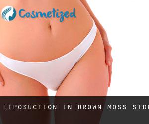 Liposuction in Brown Moss Side