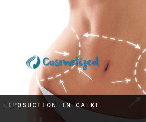 Liposuction in Calke