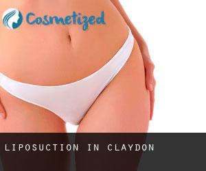 Liposuction in Claydon