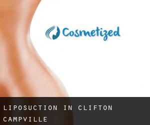 Liposuction in Clifton Campville