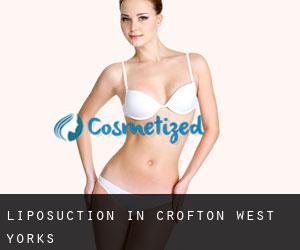 Liposuction in Crofton West Yorks