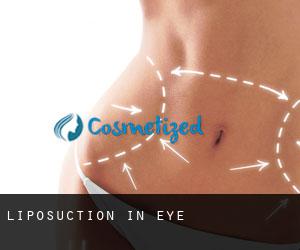 Liposuction in Eye