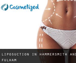 Liposuction in Hammersmith and Fulham Liposuction in Hammersmith and Fulham