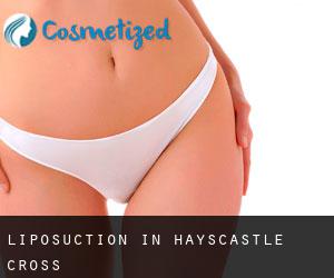 Liposuction in Hayscastle Cross
