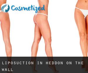 Liposuction in Heddon on the Wall