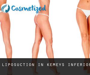 Liposuction in Kemeys Inferior