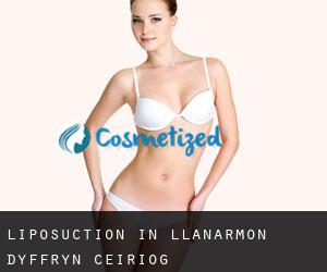 Liposuction in Llanarmon Dyffryn-Ceiriog