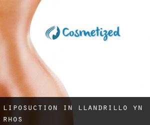 Liposuction in Llandrillo-yn-Rhôs