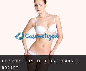 Liposuction in Llanfihangel Rogiet