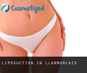 Liposuction in Llanmorlais
