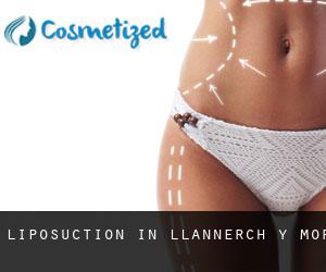 Liposuction in Llannerch-y-môr