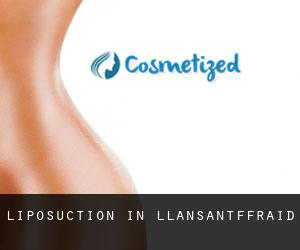 Liposuction in Llansantffraid