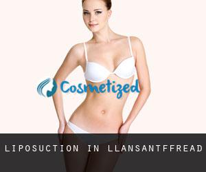 Liposuction in Llansantffread