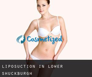 Liposuction in Lower Shuckburgh