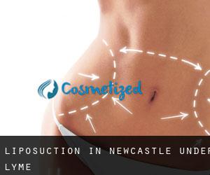Liposuction in Newcastle-under-Lyme