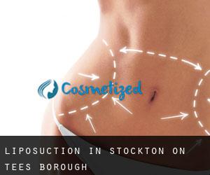 Liposuction in Stockton-on-Tees (Borough)