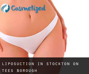 Liposuction in Stockton-on-Tees (Borough)