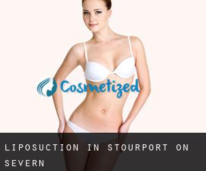 Liposuction in Stourport On Severn