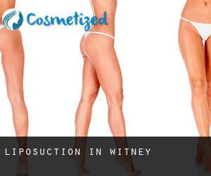 Liposuction in Witney