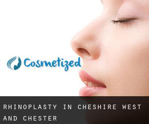Rhinoplasty in Cheshire West and Chester Rhinoplasty in Cheshire West and Chester
