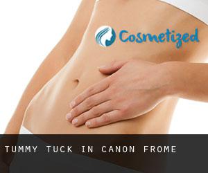 Tummy Tuck in Canon Frome