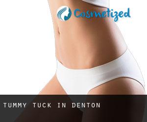 Tummy Tuck in Denton Tummy Tuck in Denton