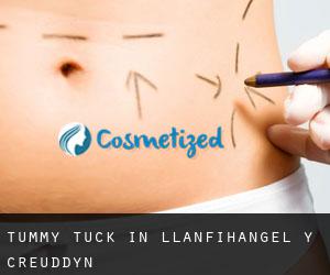 Tummy Tuck in Llanfihangel-y-creuddyn
